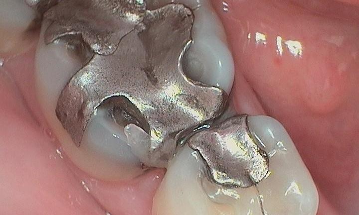 Before-Both-teeth-had-old-broken-down