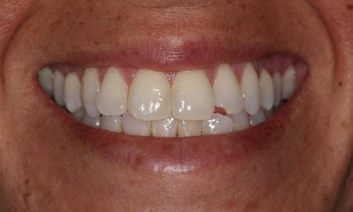 Before-Composite-restoration